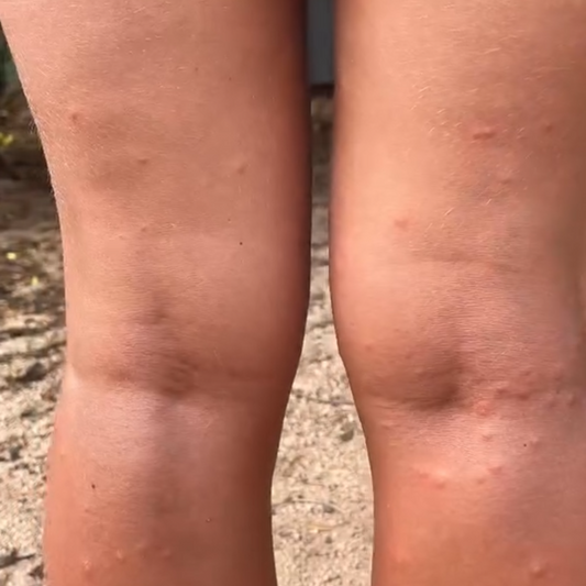 Why do I get eaten alive and others don't?